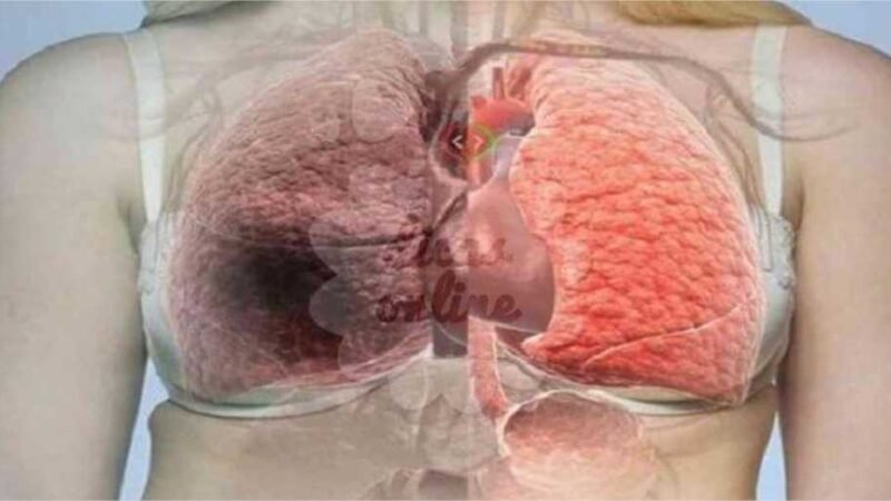 Receita caseira para limpar os pulmões e respirar melhor