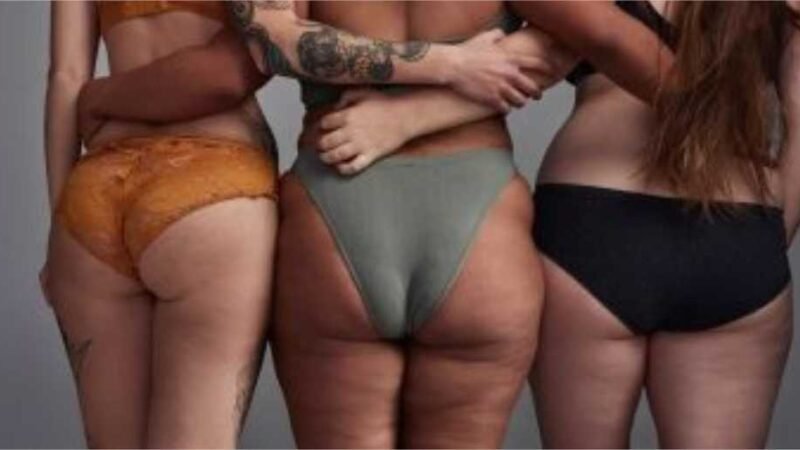 Especialista responde principais dúvidas sobre como acabar com a celulite