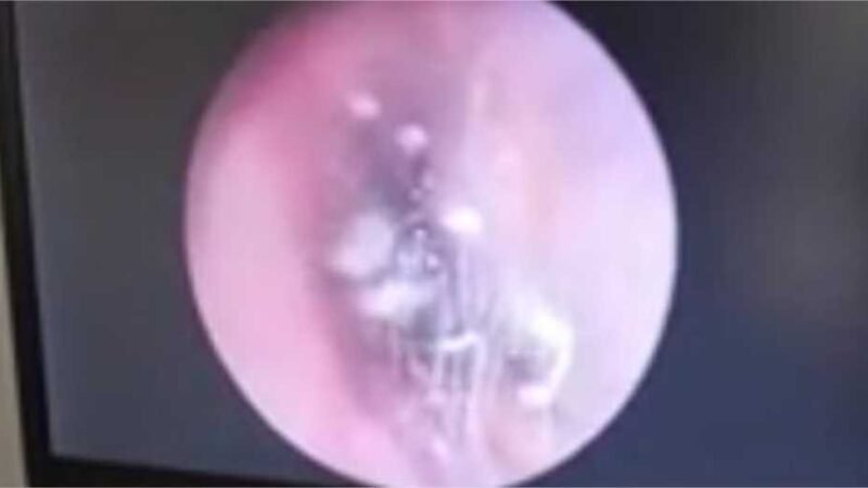 Médico descobre aranha morando no ouvido de paciente