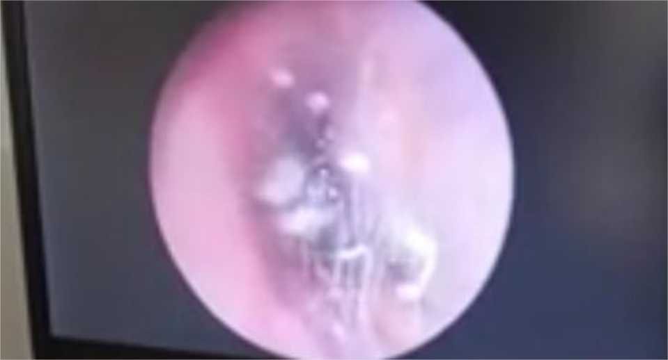 Médico descobre aranha morando no ouvido de paciente