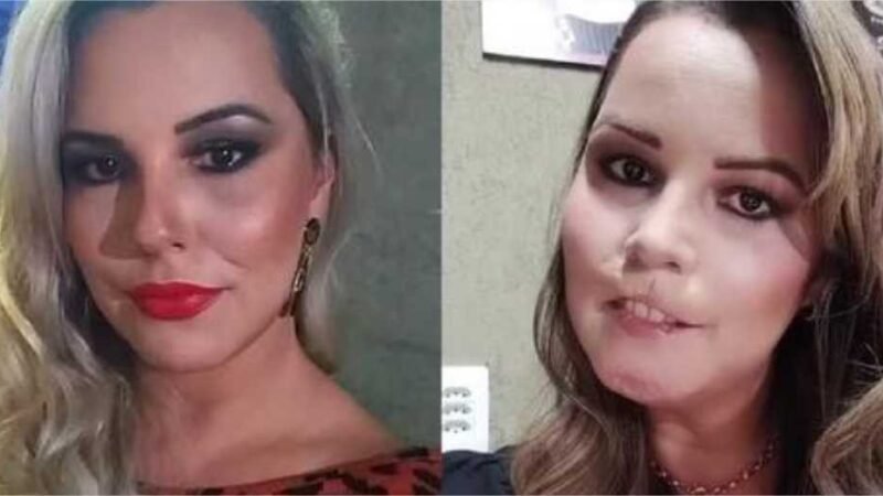 Mulher perde o lábio superior após se submeter a harmonização facial com PMMA