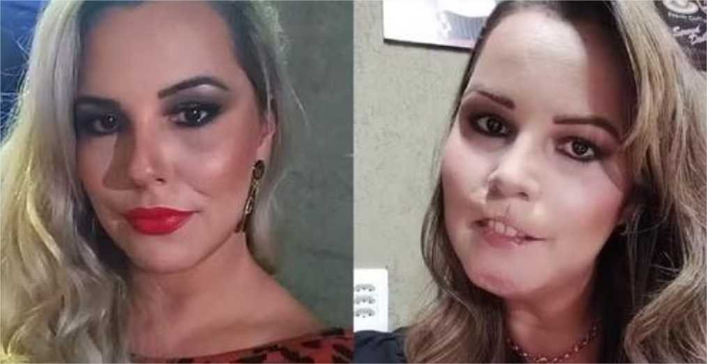 Mulher perde o lábio superior após se submeter a harmonização facial com PMMA