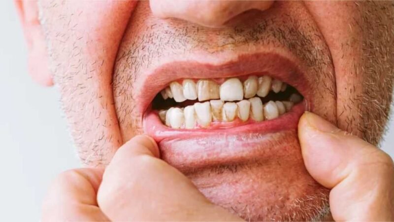 É verdade que a gengiva dos fumantes pode escurecer?