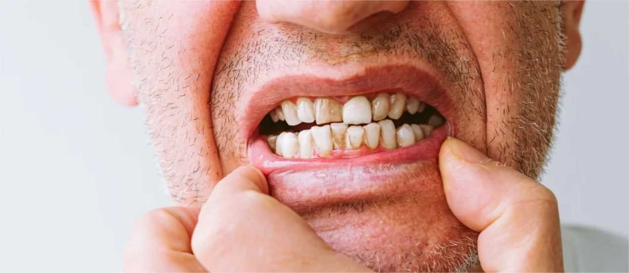 É verdade que a gengiva dos fumantes pode escurecer?