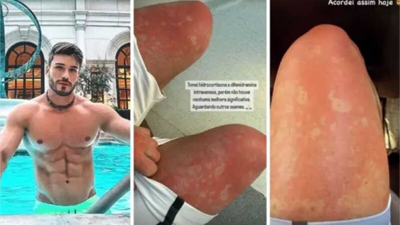 Viana surge com manchas na pele e descobre condição incurável