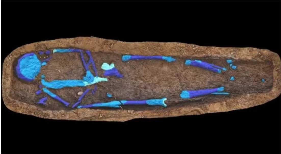 Enterro de 100 anos revela mulher com raro caso de “vesícula de porcelana”