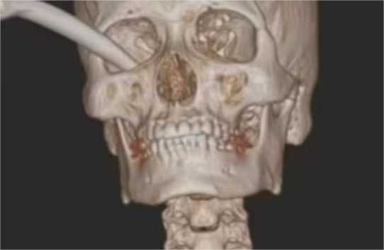 Jovem fica com o freio da moto fincado no olho