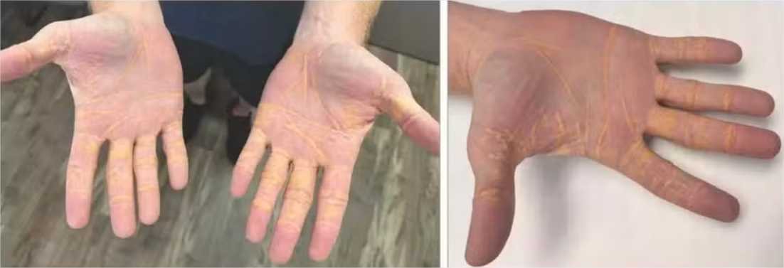 Homem adquire caroços amarelos nas mãos e pés após aderir à “dieta carnívora”