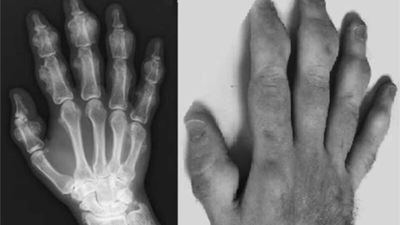 Homem sofre doença rara que faz mãos crescerem após inalar limpador de computador por anos