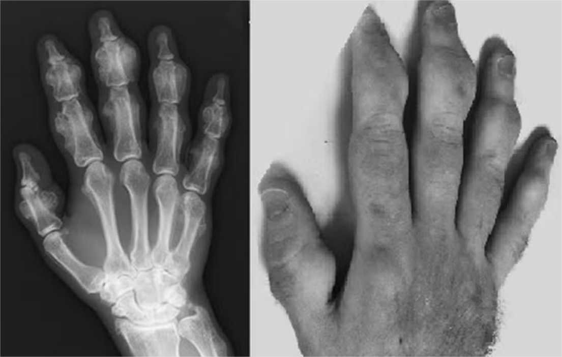 Homem sofre doença rara que faz mãos crescerem após inalar limpador de computador por anos