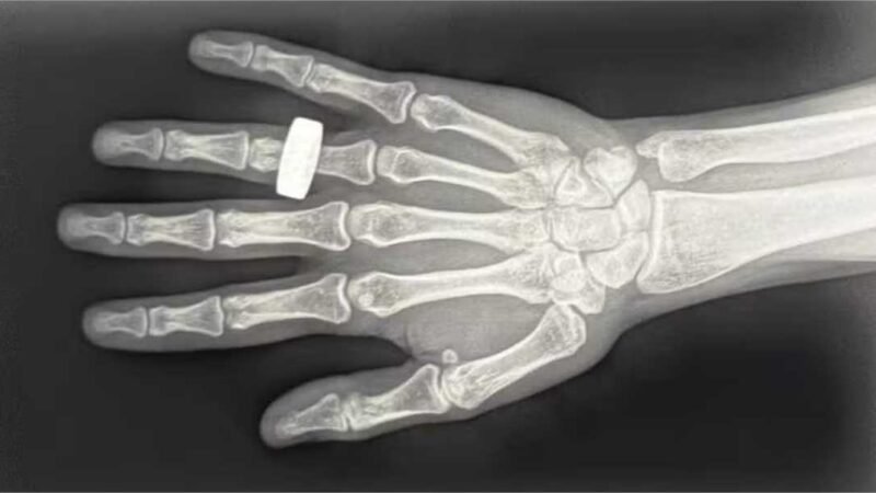 Como foi feita a primeira imagem de raio X no espaço