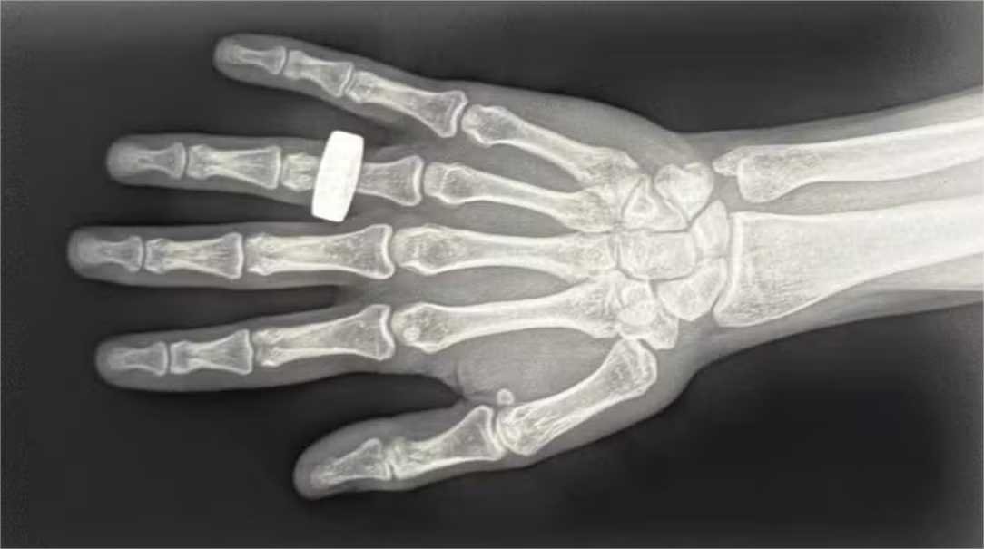 Como foi feita a primeira imagem de raio X no espaço