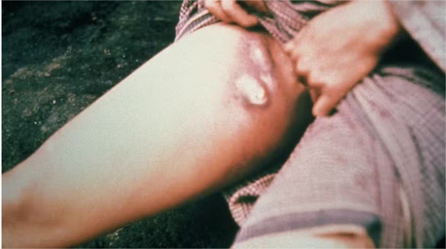 Como a bactéria da peste negra conseguiu sobreviver até os tempos modernos? Ficando menos letal