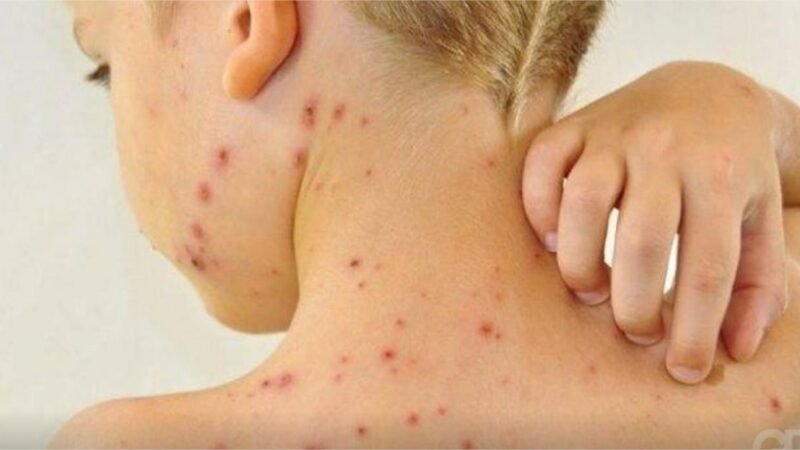 Saúde alerta para um possível surto de sarampo em Mato Grosso