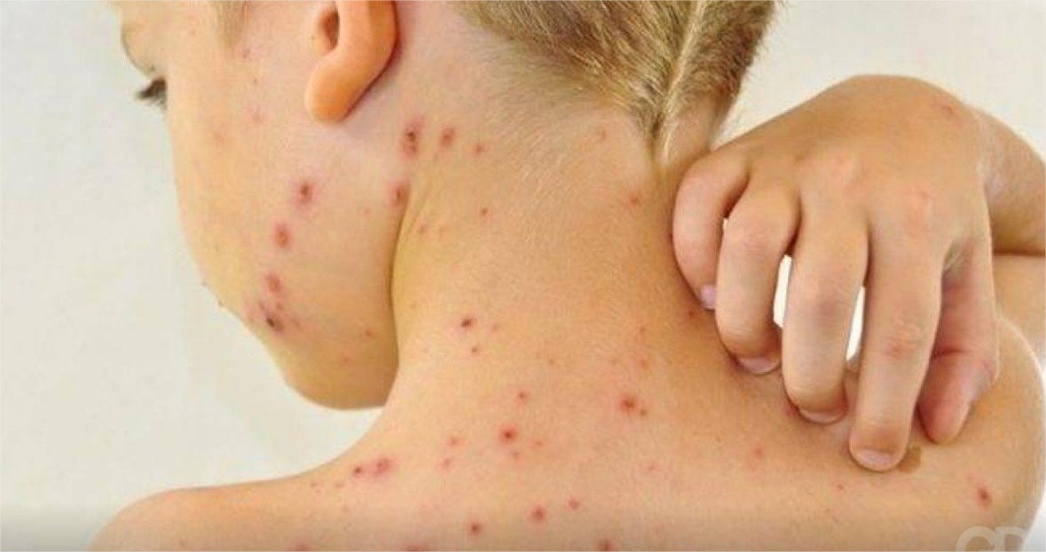 Saúde alerta para um possível surto de sarampo em Mato Grosso