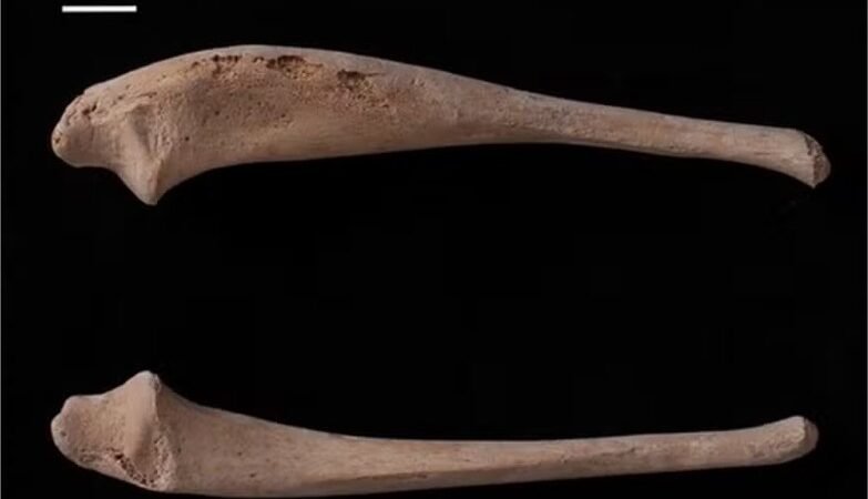 Doença rara é identificada em ossos de criança do século 12