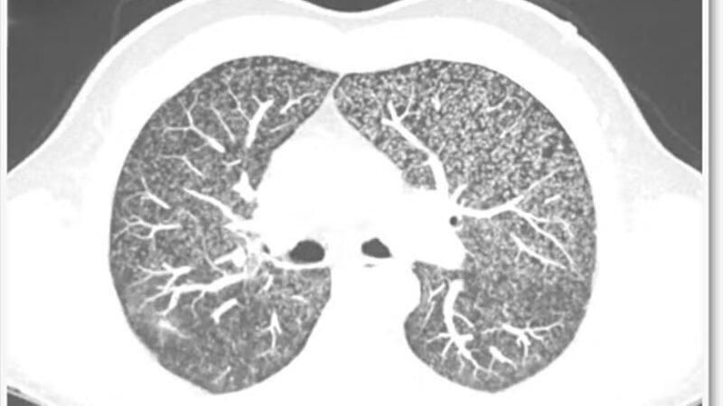 Irlandês de 57 anos contrai tuberculose rara no pênis; entenda os efeitos
