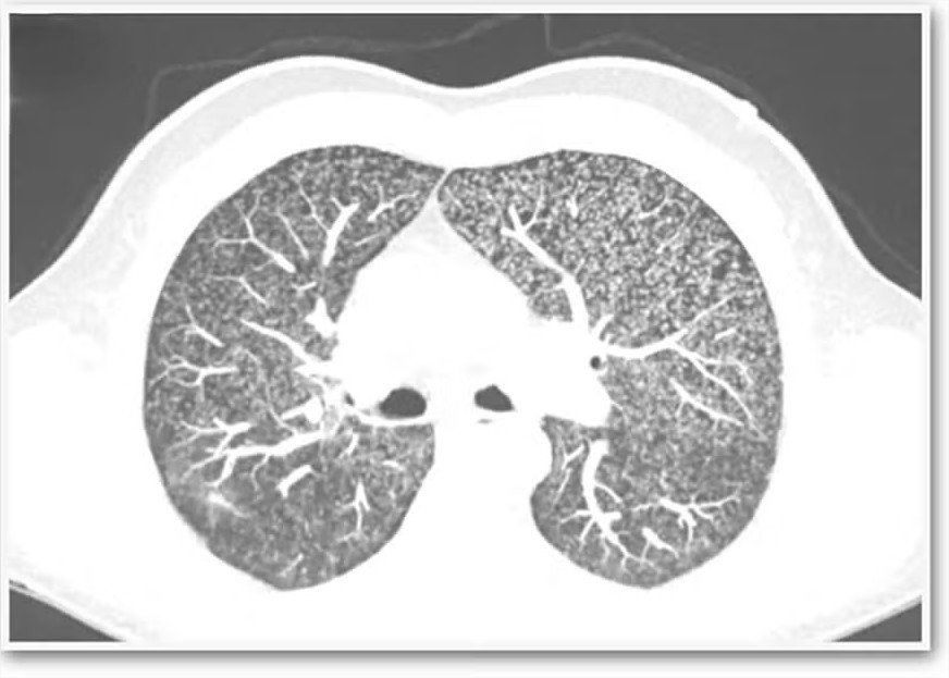Irlandês de 57 anos contrai tuberculose rara no pênis; entenda os efeitos