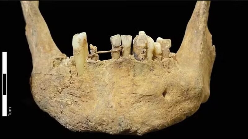 Homem consertou problema nos dentes com fio de ouro 20 quilates há 500 anos