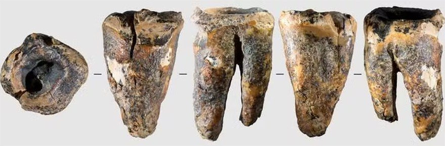 Dentistas neandertais usavam ferramentas de pedra para tratar cáries há 60 mil anos