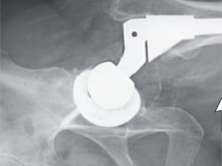 Em caso raro, mulher tem infecção por metal após prótese no quadril deslocar