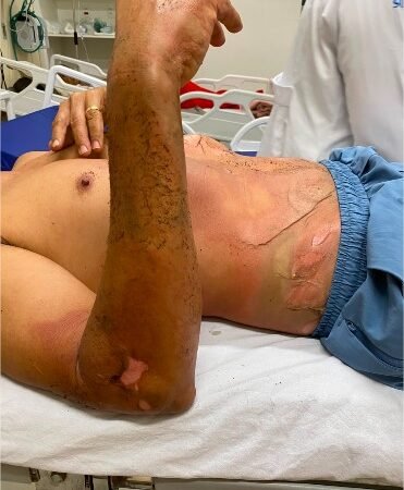 Corpo de Bombeiros socorre vítima de descarga elétrica em Cáceres