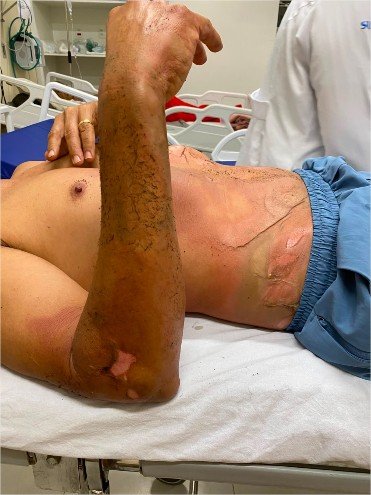 Corpo de Bombeiros socorre vítima de descarga elétrica em Cáceres