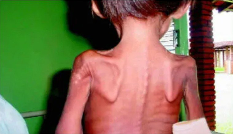 Silêncio nas aldeias: Mato Grosso é o terceiro estado do país em mortes de crianças indígenas até 4 anos