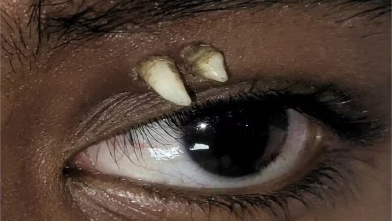 Dente cresce entre olho e sobrancelha de adolescente de 16 anos; entenda