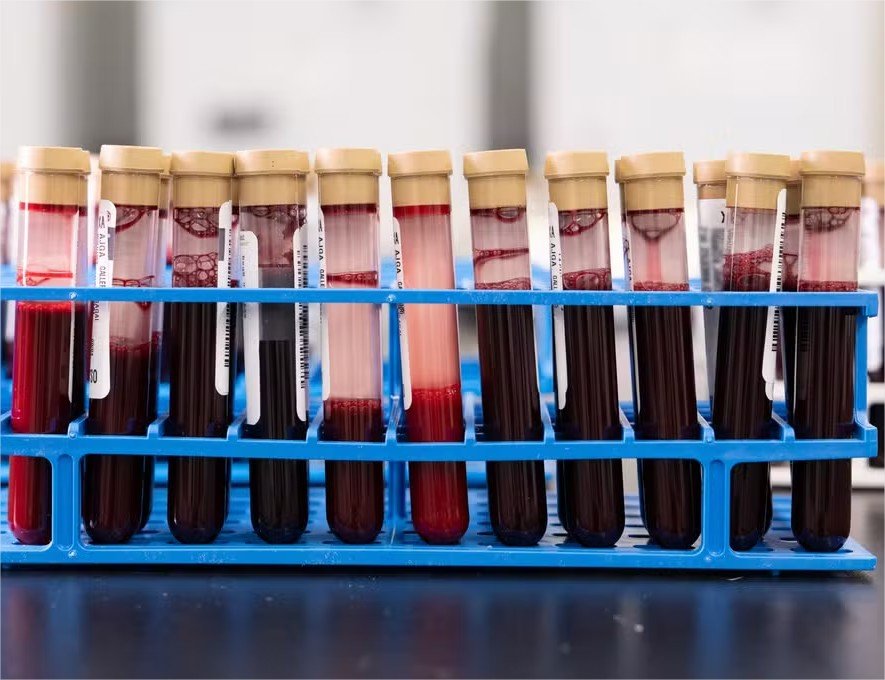 Chega ao Brasil novo exame de sangue que pode identificar 50 tipos de câncer